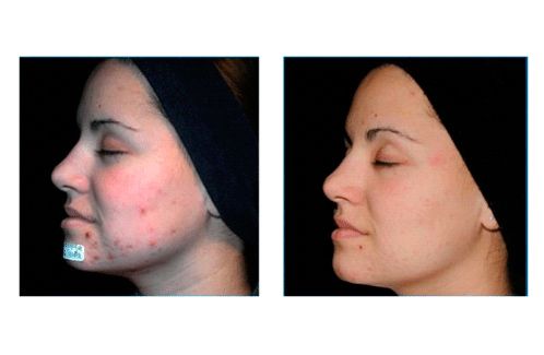 Avenida 101 peeling químico facial